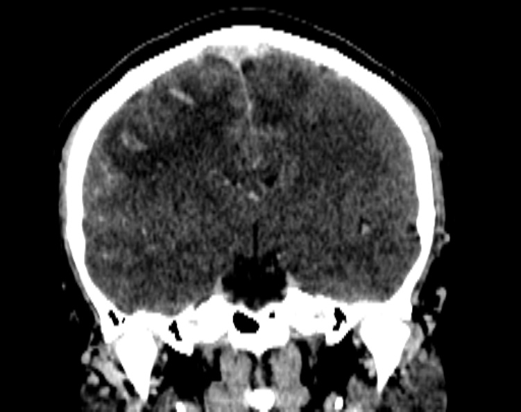 Cerebral venous hemorrhagic infarct from venous sinus thrombosis (Radiopaedia 55433-61883 Coronal C+ delayed 33).jpg