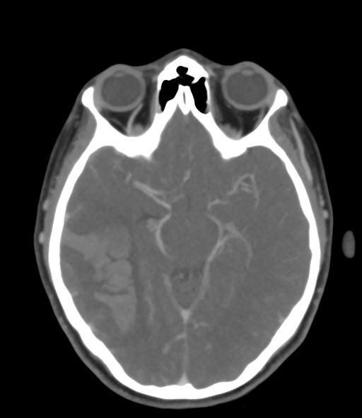 Cerebral venous hemorrhagic infarction (Radiopaedia 38461-40550 Axial MIP VENOGRAM 23).png