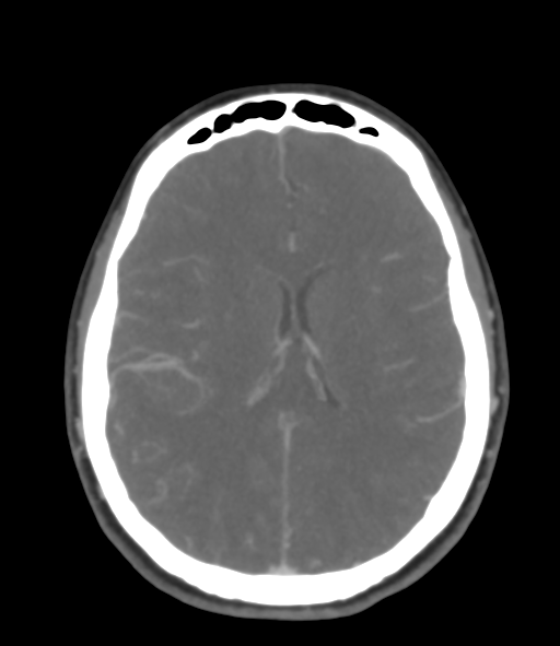 File:Cerebral venous hemorrhagic infarction (Radiopaedia 38461-40550 Axial MIP VENOGRAM 32).png