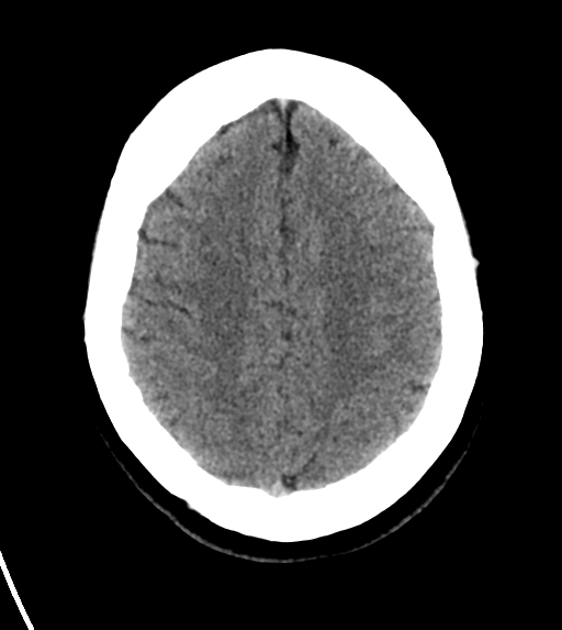 File:Cerebral venous infarct related to dural venous sinus thromboses (Radiopaedia 35292-36804 Axial non-contrast 22).png
