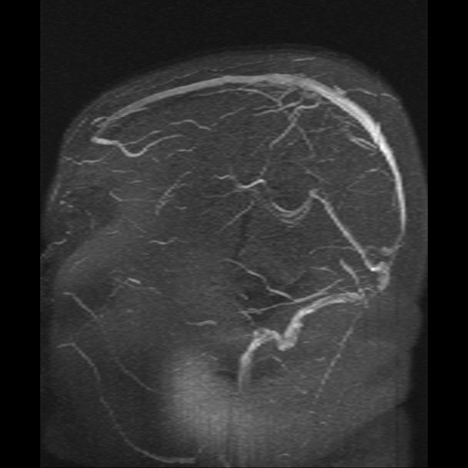 Cerebral venous infarction (Radiopaedia 25109-25396 MRV 4).jpg