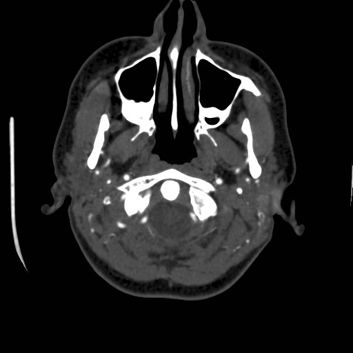 Cerebral venous sinus thrombosis (Radiopaedia 40619-43227 A 13).jpg