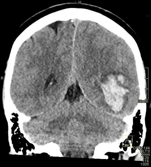 Cerebral venous sinus thrombosis (Radiopaedia 91329-108965 Coronal non-contrast 39).jpg