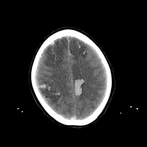 Cerebral venous throbmosis - hemorrhagic venous infarction (Radiopaedia 87318-103613 Axial non-contrast 122).jpg