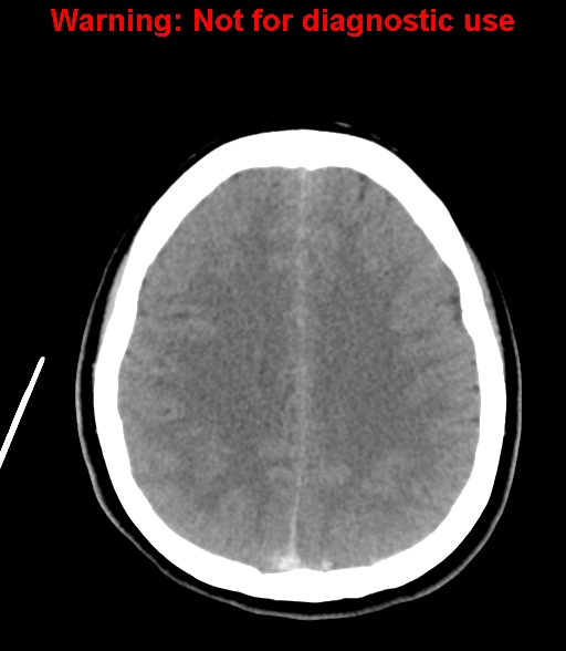 File:Cerebral venous thrombosis (Radiopaedia 37224-38992 Axial non-contrast 20).jpg
