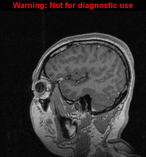 File:Cerebral venous thrombosis (Radiopaedia 37224-39208 Sagittal T1 C+ 35).jpg
