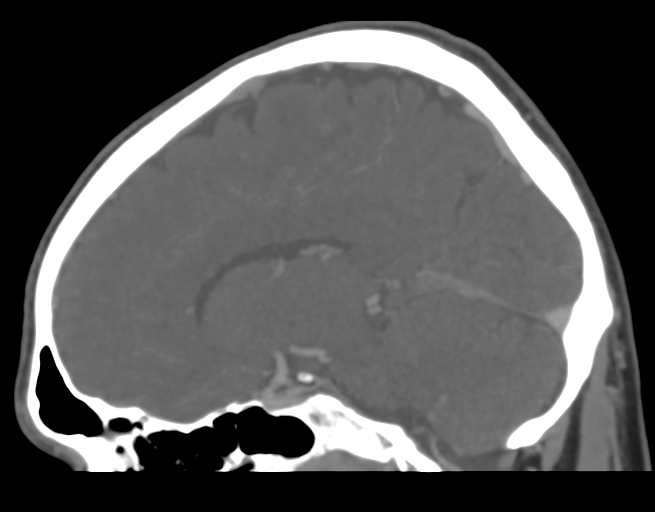 Cerebral venous thrombosis (Radiopaedia 38392-40467 D 23).png
