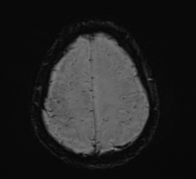 Cerebral venous thrombosis (Radiopaedia 71207-81504 Axial SWI 43).jpg