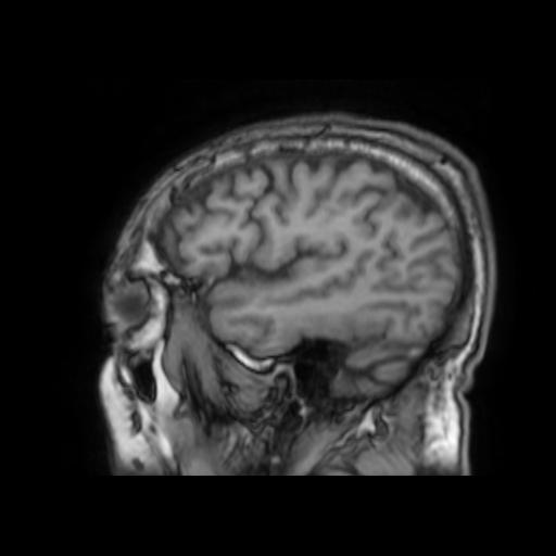 File:Cerebral venous thrombosis with secondary intracranial hypertension (Radiopaedia 89842-106957 Sagittal T1 7).jpg