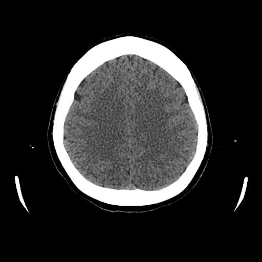Cerebral venous thrombosis with venous hemorrhagic infarct (Radiopaedia 90354-107660 Axial non-contrast 36).jpg