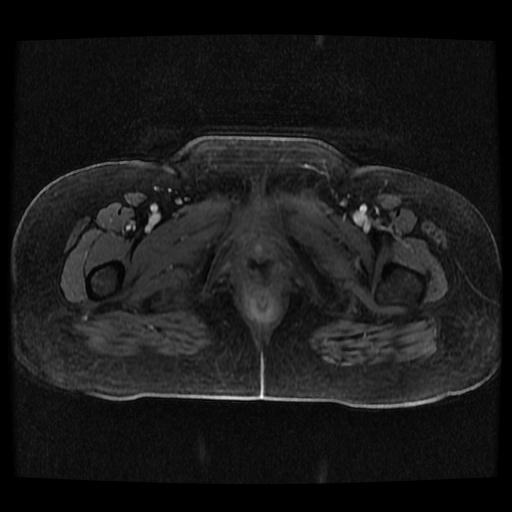 Cervical carcinoma (Radiopaedia 70924-81132 Axial T1 C+ fat sat 109).jpg