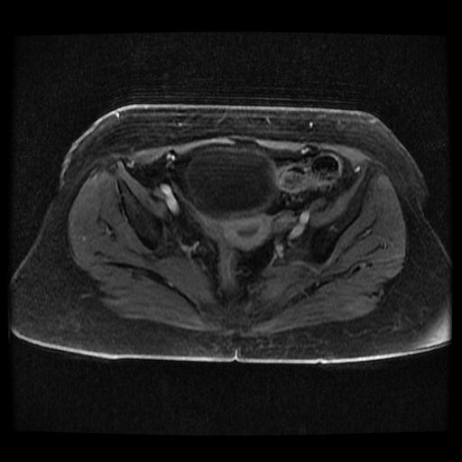 Cervical carcinoma (Radiopaedia 70924-81132 Axial T1 C+ fat sat 146).jpg
