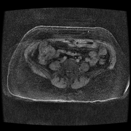 Cervical carcinoma (Radiopaedia 70924-81132 Axial T1 C+ fat sat 175).jpg