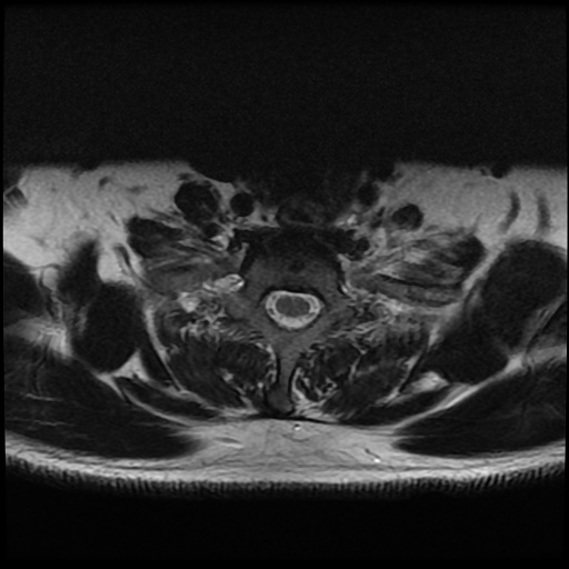 File:Cervical disc extrusion (Radiopaedia 59074-66364 Axial T2 17).jpg