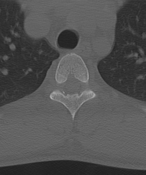 Cervical intercalary bone (Radiopaedia 35211-36748 Axial bone window 74).png