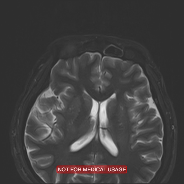 File:Cervical nerve schwannoma (Radiopaedia 27964-28221 C 4).jpg