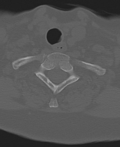 Cervical spine ACDF loosening (Radiopaedia 48998-54071 Axial bone window 50).png