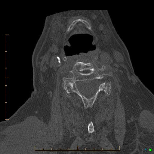 File:Cervical spine fracture - ankylosing spondylitis (Radiopaedia 76835-88706 Axial bone window 129).jpg