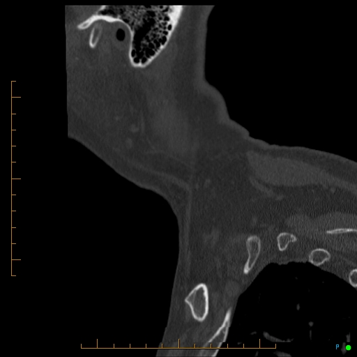 File:Cervical spine fracture - ankylosing spondylitis (Radiopaedia 76835-88706 Sagittal bone window 4).jpg