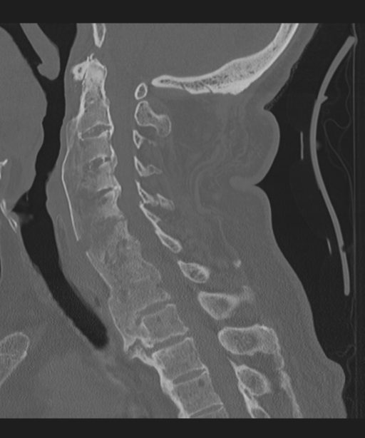 Cervical spine fracture in the setting of ankylosis (Radiopaedia 37038-38715 Sagittal bone window 42).png