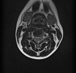 File:Cervical spondylodiscitis and calvarial hemangioma (Radiopaedia 64317-73104 Axial T2 4).jpg