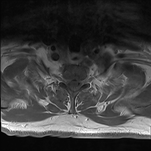 File:Cervical tumor-like myelopathy due to Type V dAVF (Radiopaedia 82461-96604 Axial T1 C+ fat sat 34).jpg