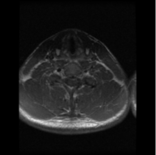 File:Cervical vertebrae metastasis (Radiopaedia 78814-91667 Axial T1 C+ 5).png