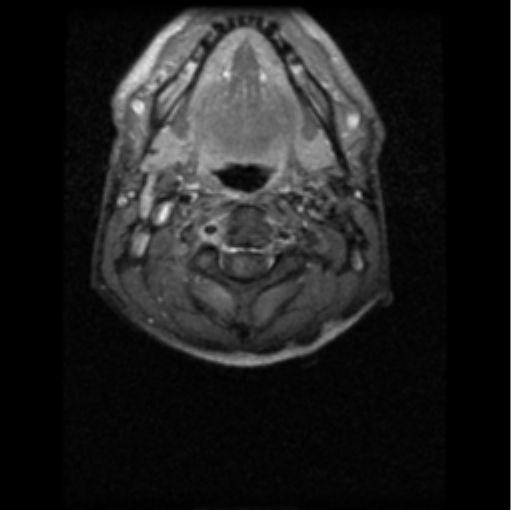 File:Cervical vertebrae metastasis (Radiopaedia 78814-91667 Axial T1 C+ fat sat 6).png