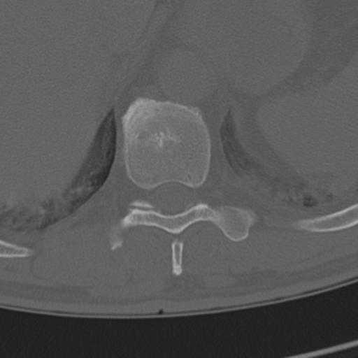 Chance fracture (Radiopaedia 33854-35020 Axial bone window 72).png