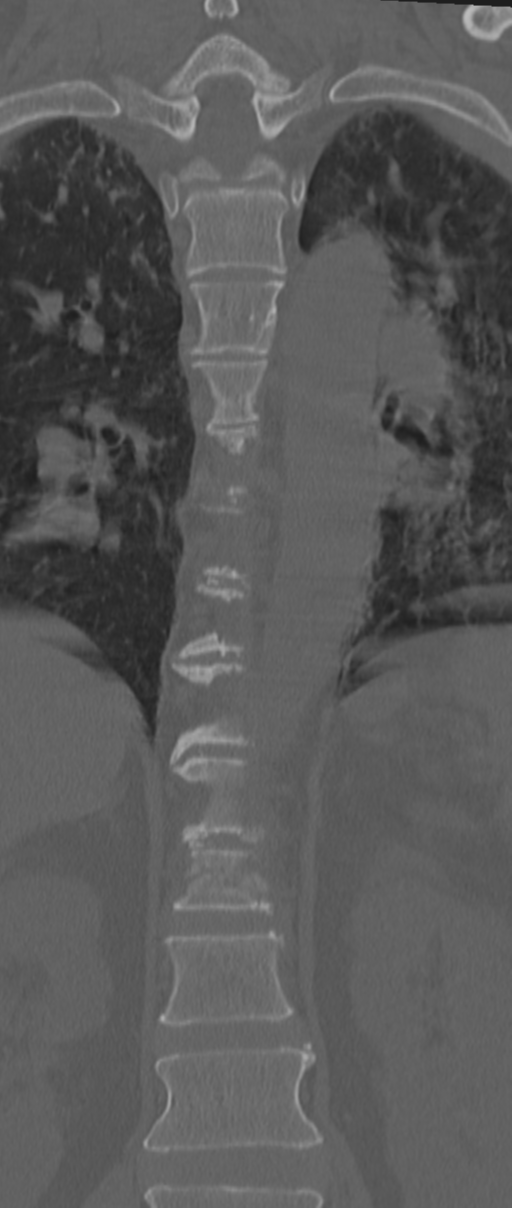 Chance fracture (Radiopaedia 33854-35020 Coronal bone window 38).png