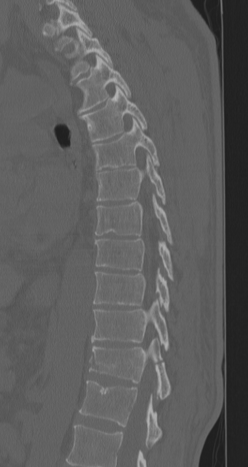 Chance fracture (Radiopaedia 33854-35020 Sagittal bone window 38).png