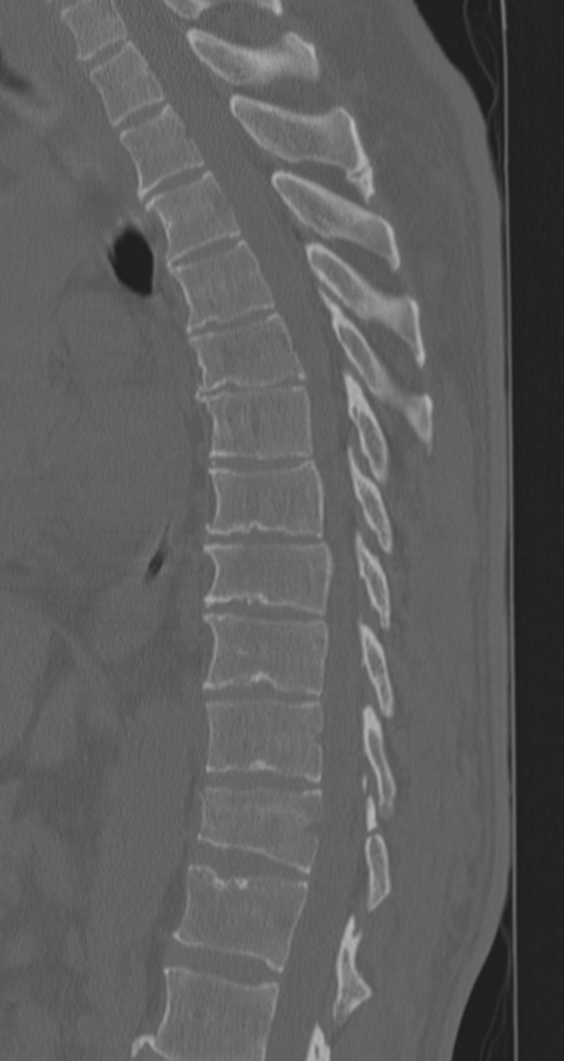 Chance fracture (Radiopaedia 33854-35020 Sagittal bone window 46).png