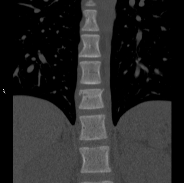 File:Chance fracture (Radiopaedia 36521-38081 Coronal bone window 8).jpg