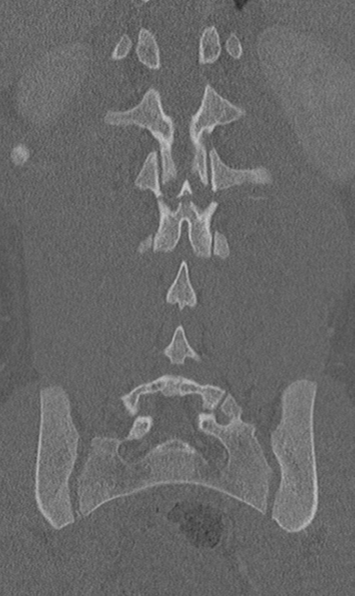 Chance fracture (Radiopaedia 40360-42912 Coronal bone window 49).png