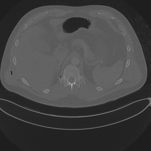 File:Chest multitrauma - aortic injury (Radiopaedia 34708-36147 Axial bone window 290).png