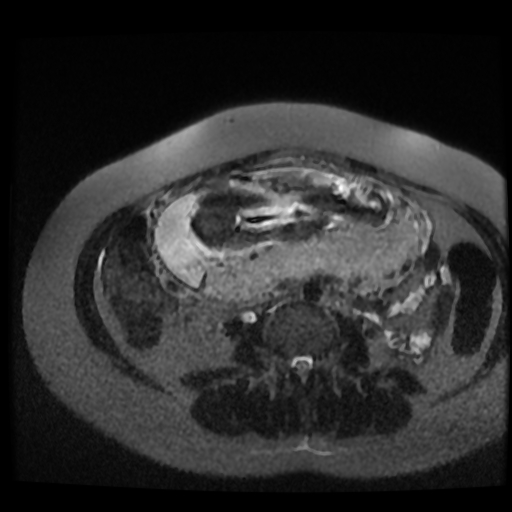 Chiari II malformation - fetal MRI (Radiopaedia 68099-77581 Axial T2-SSFSE 7).jpg