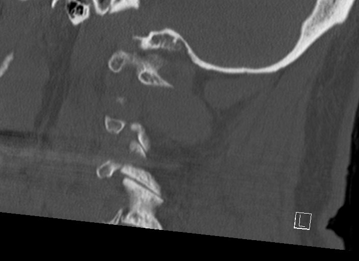 Chiari I malformation with a symptomatic syrinx of the posterolateral medulla oblongata (Radiopaedia 42573-45707 A 17).jpg