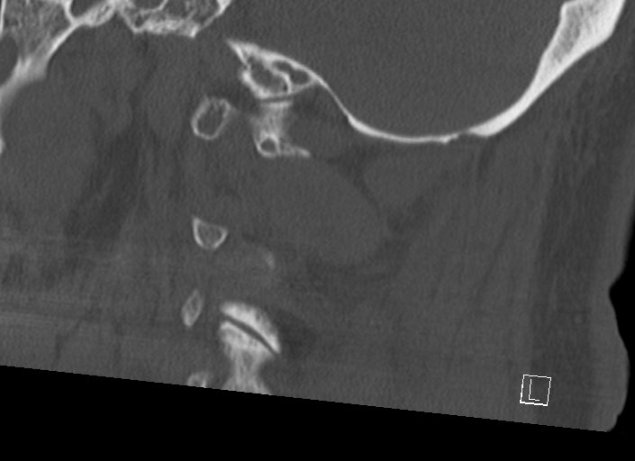 Chiari I malformation with a symptomatic syrinx of the posterolateral medulla oblongata (Radiopaedia 42573-45707 A 43).jpg