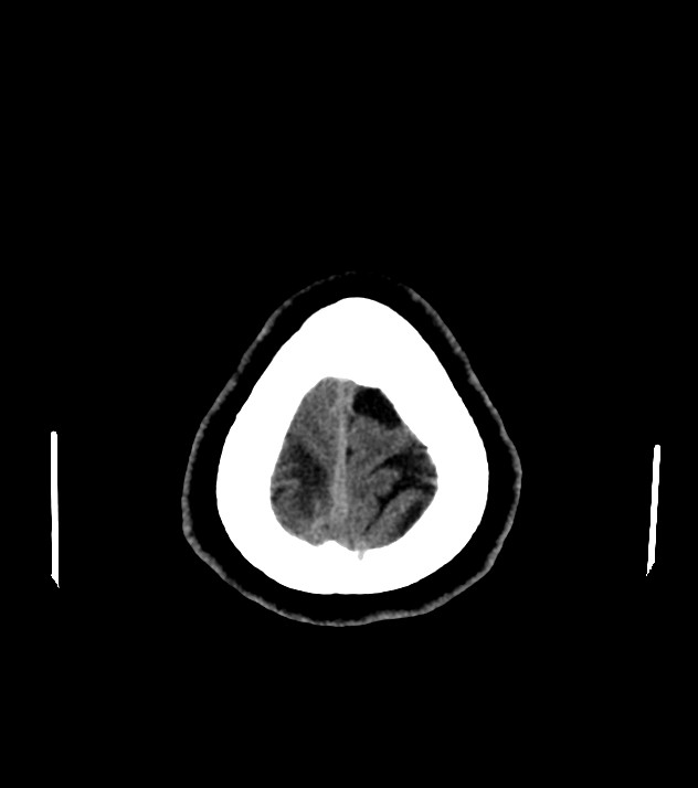Cholangiocarcinoma with cerebral metastases (Radiopaedia 83519-98628 Axial non-contrast 60).jpg
