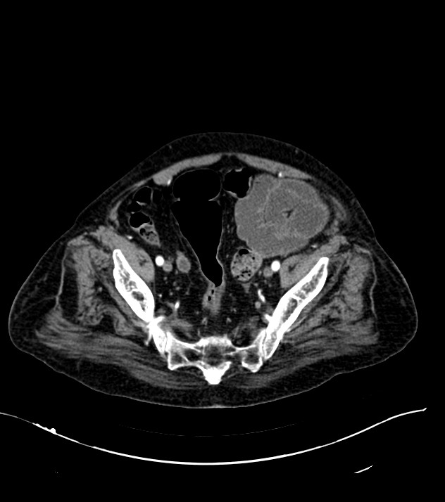 Cholangiocarcinoma with cerebral metastases (Radiopaedia 83519-98629 B 103).jpg