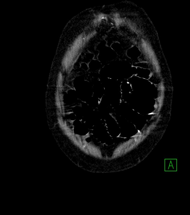 Cholangiocarcinoma with cerebral metastases (Radiopaedia 83519-98629 E 9).jpg