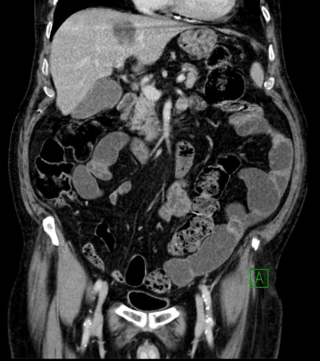 Cholangiocarcinoma with cerebral metastases (Radiopaedia 83519-98629 G 34).jpg
