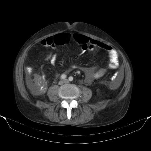 File:Cholangitis and abscess formation in a patient with cholangiocarcinoma (Radiopaedia 21194-21100 A 31).jpg