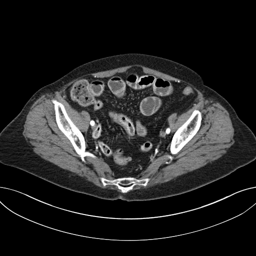 Cholecystoduodenal fistula due to calculous cholecystitis with gallstone migration (Radiopaedia 86875-103077 A 60).jpg