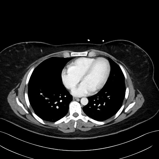 File:Choledocholithiasis after recent cholecystectomy (Radiopaedia 60929-68737 Axial 71).jpg