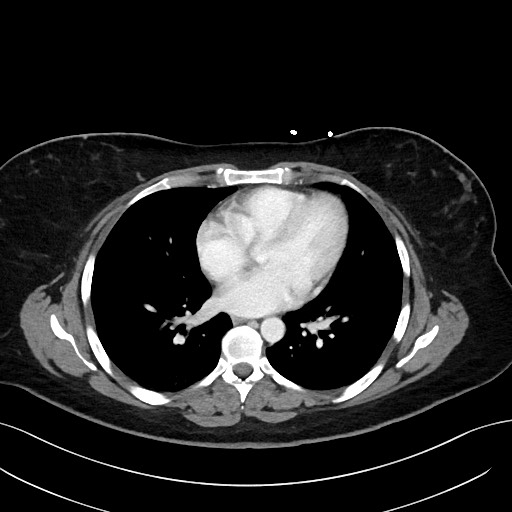 File:Choledocholithiasis after recent cholecystectomy (Radiopaedia 60929-68737 Axial 75).jpg