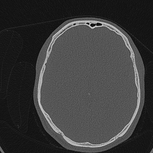 Cholesteatoma (Radiopaedia 70429-80529 Axial bone window 154).jpg
