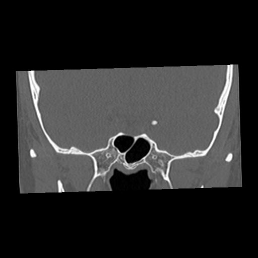 Cholesteatoma (Radiopaedia 84960-100474 Coronal bone window 5).jpg