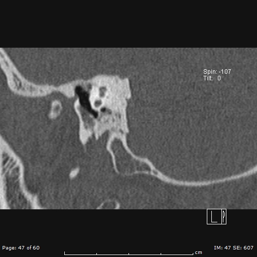 File:Cholesteatoma - external auditory canal (Radiopaedia 88452-105096 Sagittal bone window 47).jpg