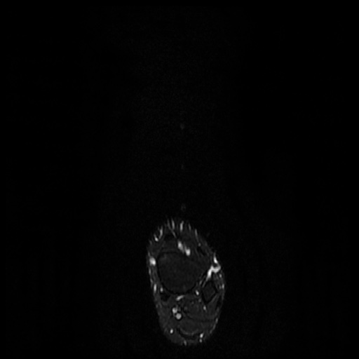 File:Chondroblastoma - midfoot (Radiopaedia 64831-73765 Long axis T2 fat sat 22).jpg